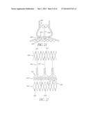 Methods For Transluminal Delivery Of Prosthetic Valves diagram and image