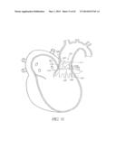 Methods For Transluminal Delivery Of Prosthetic Valves diagram and image