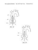 Methods For Transluminal Delivery Of Prosthetic Valves diagram and image