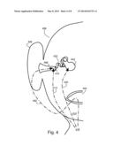 Reducing Occlusion Effect in ANR Headphones diagram and image