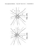 METHODS FOR DETECTION OF CARDIAC RHYTHM DISORDERS USING BASKET STYLE     CARDIAC MAPPING CATHETER diagram and image