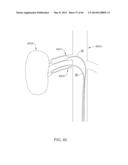 FLEX CIRCUIT/BALLOON ASSEMBLIES UTILIZING TEXTURED SURFACES FOR ENHANCED     BONDING diagram and image