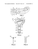 Volar Fixation System with Fixed-Angle Multi-Hole Drill Guide diagram and image