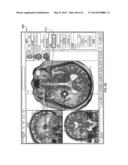 IMAGE-GUIDED THERAPY OF A TISSUE diagram and image