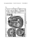 IMAGE-GUIDED THERAPY OF A TISSUE diagram and image