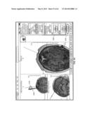 IMAGE-GUIDED THERAPY OF A TISSUE diagram and image