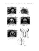 DEVICE TO NARROW THE COLUMELLA AND TO DILATE THE NASAL VALVE diagram and image