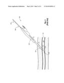 SNAP-ON VASCULAR CLOSURE DEVICE AND METHODS diagram and image