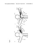 ENDOVASCULAR PROSTHESIS AND DELIVERY DEVICE diagram and image