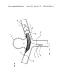 ENDOVASCULAR PROSTHESIS AND DELIVERY DEVICE diagram and image