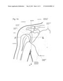 IMPLANTABLE GLENOID PROSTHESES diagram and image
