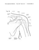 IMPLANTABLE GLENOID PROSTHESES diagram and image