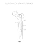 Methods and Devices for a Surgical Hip Replacement Procedure diagram and image