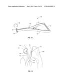 Methods and Devices for a Surgical Hip Replacement Procedure diagram and image