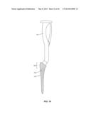 Methods and Devices for a Surgical Hip Replacement Procedure diagram and image