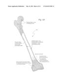 BIOLOGIC ARTIFICIAL BONE diagram and image