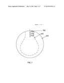 Refractive-Diffractive Multifocal Lens diagram and image