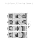 Compositions for Diagnosis and Therapy of Diseases Associated with     Aberrant Expression of Futrins (R-Spondins) and/or Wnt diagram and image