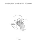 Method And System For Aligning A Prosthesis During Surgery Using Active     Sensors diagram and image