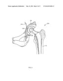 Method And System For Aligning A Prosthesis During Surgery Using Active     Sensors diagram and image