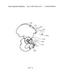 Method And System For Aligning A Prosthesis During Surgery Using Active     Sensors diagram and image