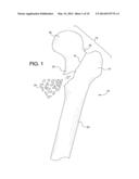 FEMORAL FRACTURE FIXATION DEVICE diagram and image