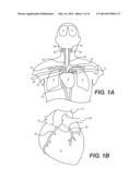 Embolism Deflector diagram and image