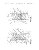 Embolism Deflector diagram and image