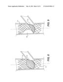 Embolism Deflector diagram and image