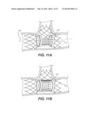 Embolism Deflector diagram and image