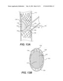 Embolism Deflector diagram and image