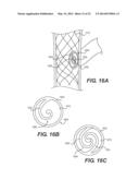 Embolism Deflector diagram and image