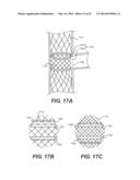 Embolism Deflector diagram and image