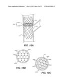 Embolism Deflector diagram and image