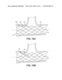 Embolism Deflector diagram and image