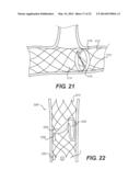 Embolism Deflector diagram and image