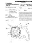 LEFT ATRIAL APPENDAGE CLOSURE IMPLANT diagram and image