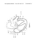 LEFT ATRIAL APPENDAGE CLOSURE IMPLANT diagram and image