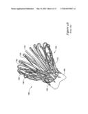 LEFT ATRIAL APPENDAGE CLOSURE IMPLANT diagram and image