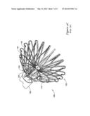 LEFT ATRIAL APPENDAGE CLOSURE IMPLANT diagram and image