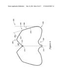 LEFT ATRIAL APPENDAGE CLOSURE IMPLANT diagram and image