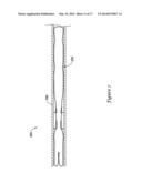 LEFT ATRIAL APPENDAGE CLOSURE IMPLANT diagram and image