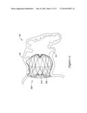 LEFT ATRIAL APPENDAGE CLOSURE IMPLANT diagram and image