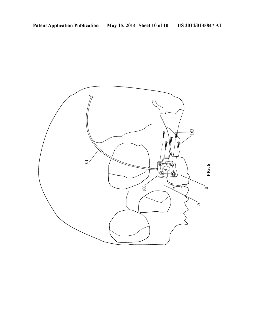 Methods for Repairing Craniomaxillofacial Bones Using Customized Bone     Plate - diagram, schematic, and image 11
