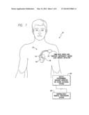 SYSTEMS AND METHODS FOR EARLY DETECTION OF LEAD BREACHES USING CROSS-LEAD     IMPEDANCES DETECTED BY AN IMPLANTABLE MEDICAL DEVICE diagram and image