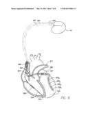 SYSTEMS AND METHODS FOR EARLY DETECTION OF LEAD BREACHES USING CROSS-LEAD     IMPEDANCES DETECTED BY AN IMPLANTABLE MEDICAL DEVICE diagram and image