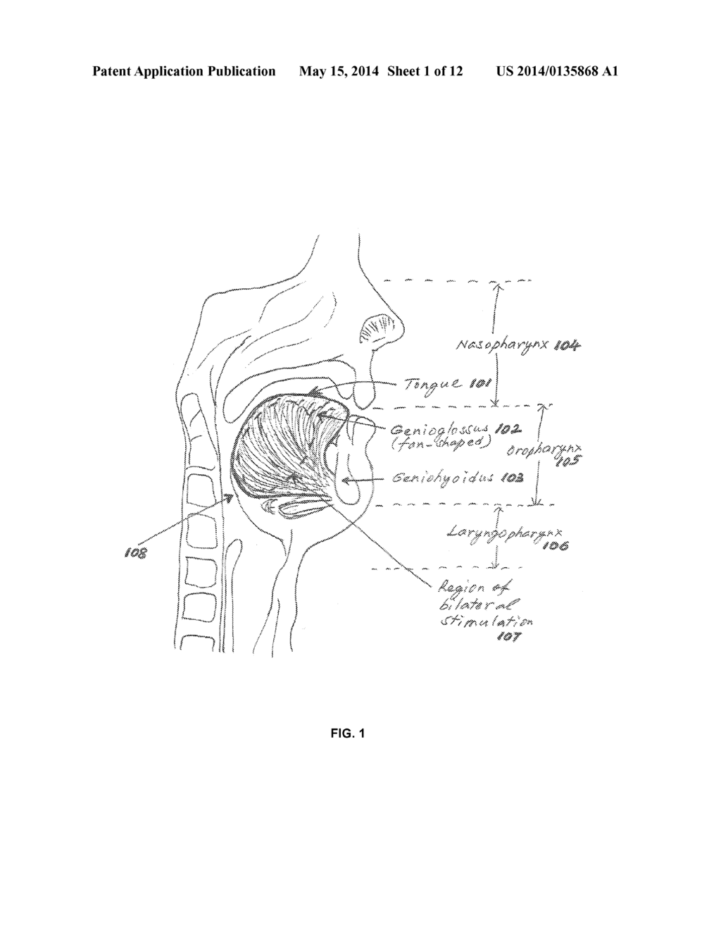 NON-INVASIVE INTRAORAL ELECTRICAL STIMULATOR SYSTEM AND METHOD FOR     TREATMENT OF OBSTRUCTIVE SLEEP APNEA (OSA) - diagram, schematic, and image 02