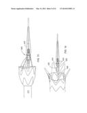 Methods Of Implanting A Prosthesis And Treating An Aneurysm diagram and image