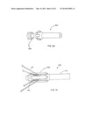 Methods Of Implanting A Prosthesis And Treating An Aneurysm diagram and image