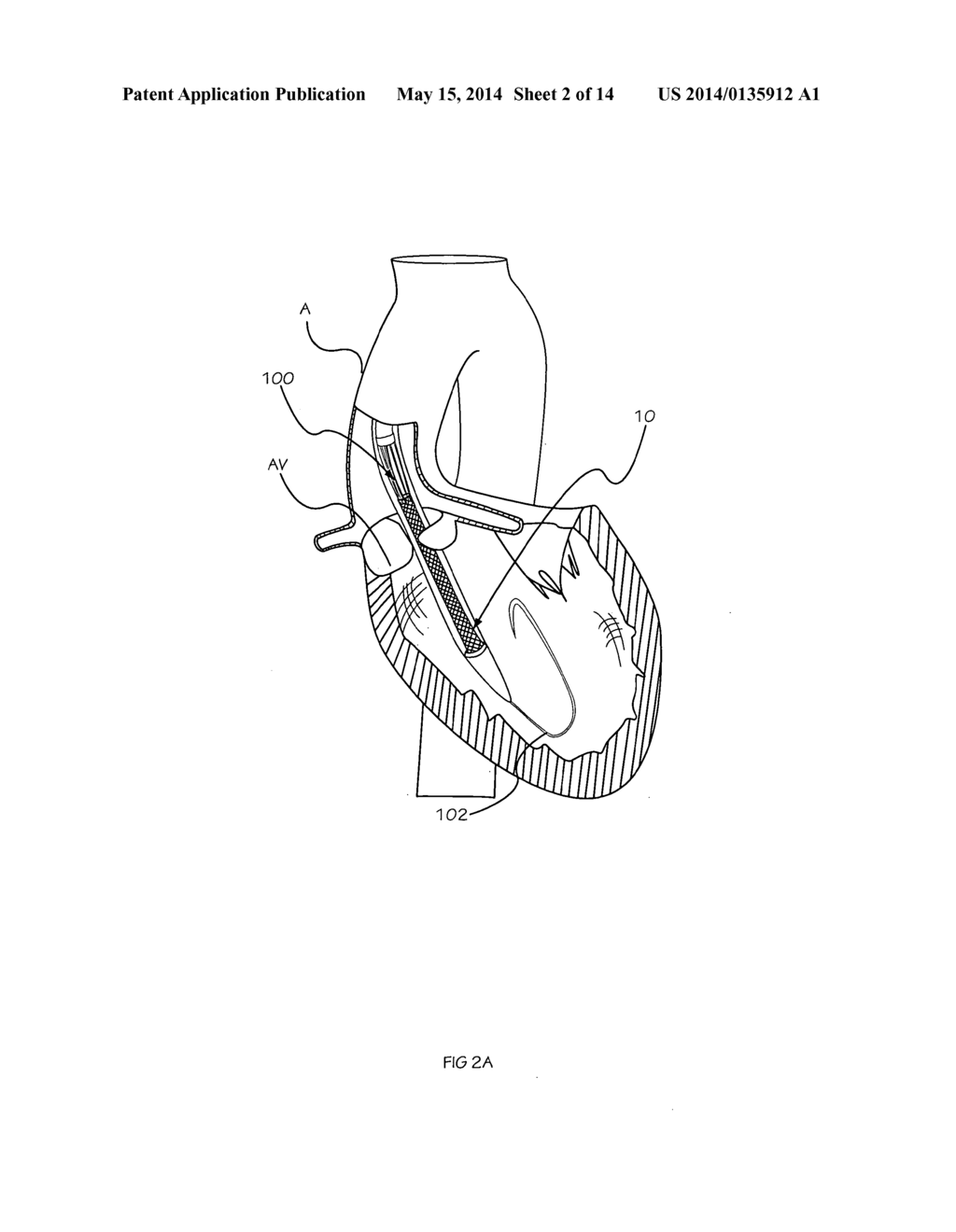 Methods and Apparatus for Performing Valvuloplasty - diagram, schematic, and image 03